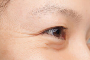 Mid-age woman showing wrinkles around her eye 