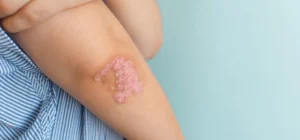 Ayurvedic eczema treatment in pune