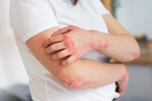 Ayurvedic fungal infection treatment in Pune