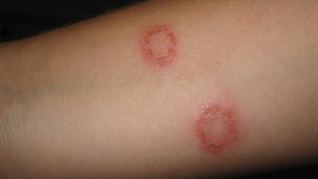 Ayurvedic Ringworm Treatment in pune