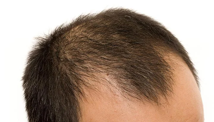 Ayurvedic Baldness treatment in pune (allopecia)