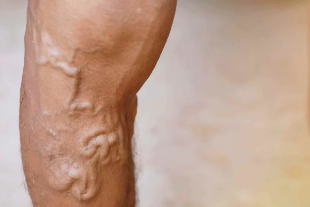 Ayurvedic Vericose Veins Treatment in Pune