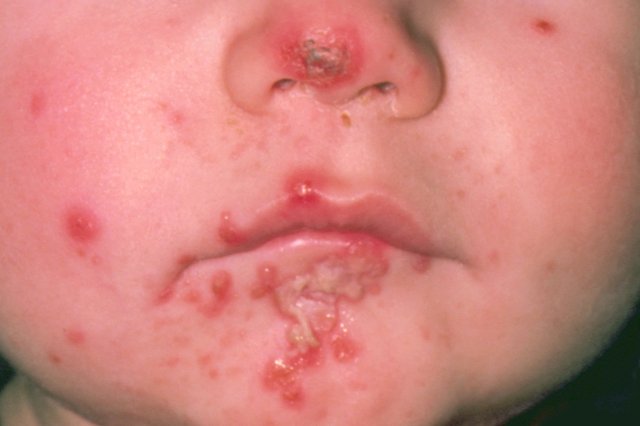 Ayurvedic ImpetigoTreatment in Pune