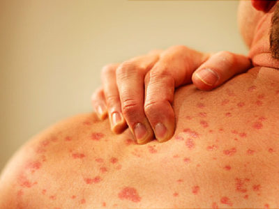 Ayurvedic urticaria treatment in pune