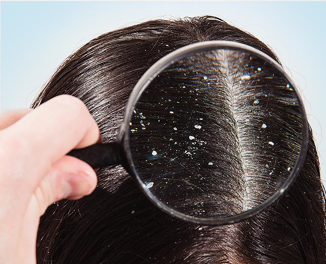 Ayurvedic dandruff treatment in pune