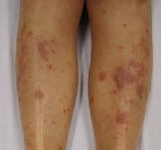 Ayurvedic lichen planus treatment in pune