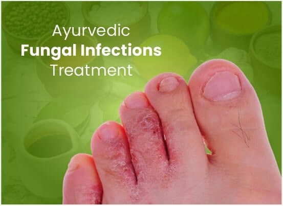 Ayurvedic Fungal Infections Treatment in Pune