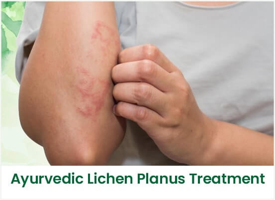 Ayurvedic Lichen Planus Treatment