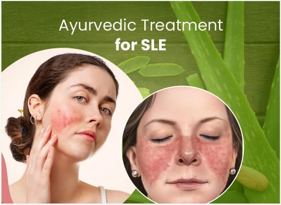 Ayurvedic Systemic Lupus Erythematosus (SLE) Treatment in Pune