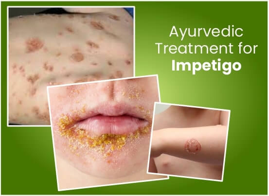 Ayurvedic Impetigo Treatment in Pune