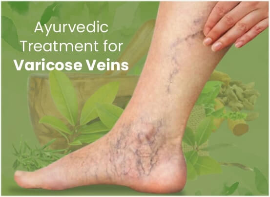 Ayurvedic Varicose Veins Treatment in Pune