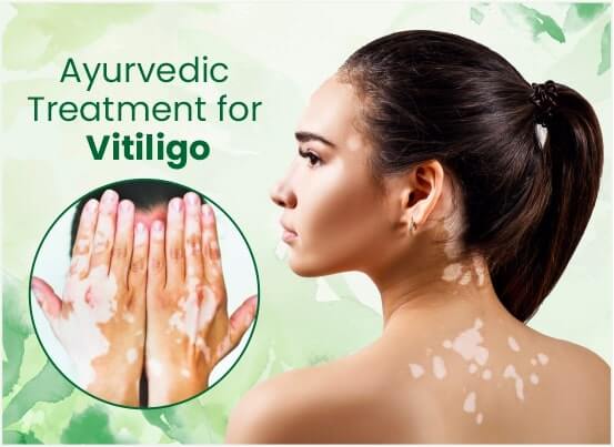 Ayurvedic Vitiligo Treatment in Pune