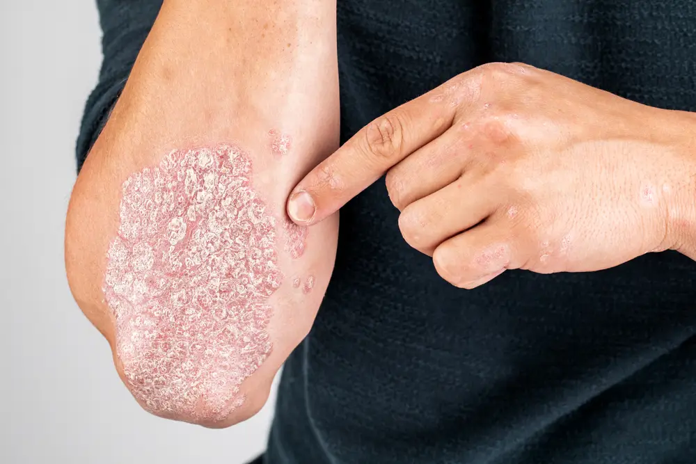 Ayurvedic Psoriasis Treatment in Pune