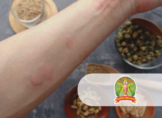 Ayurvedic Urticaria Treatment in Pune at Shree Vishwarpan Ayurved Clinic by Dr. Prafulla and Snehal Raut